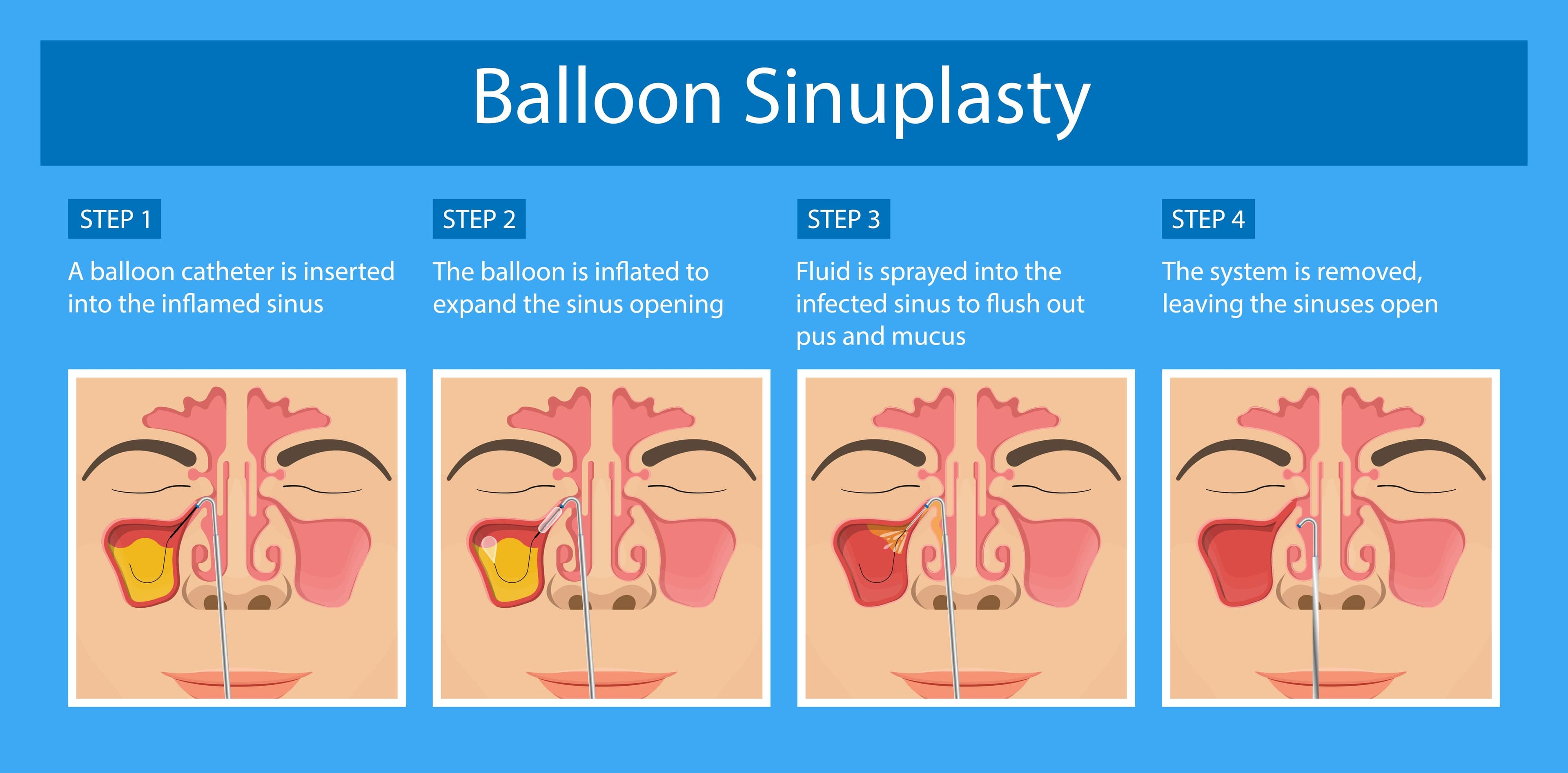 Balloon Sinuplasty