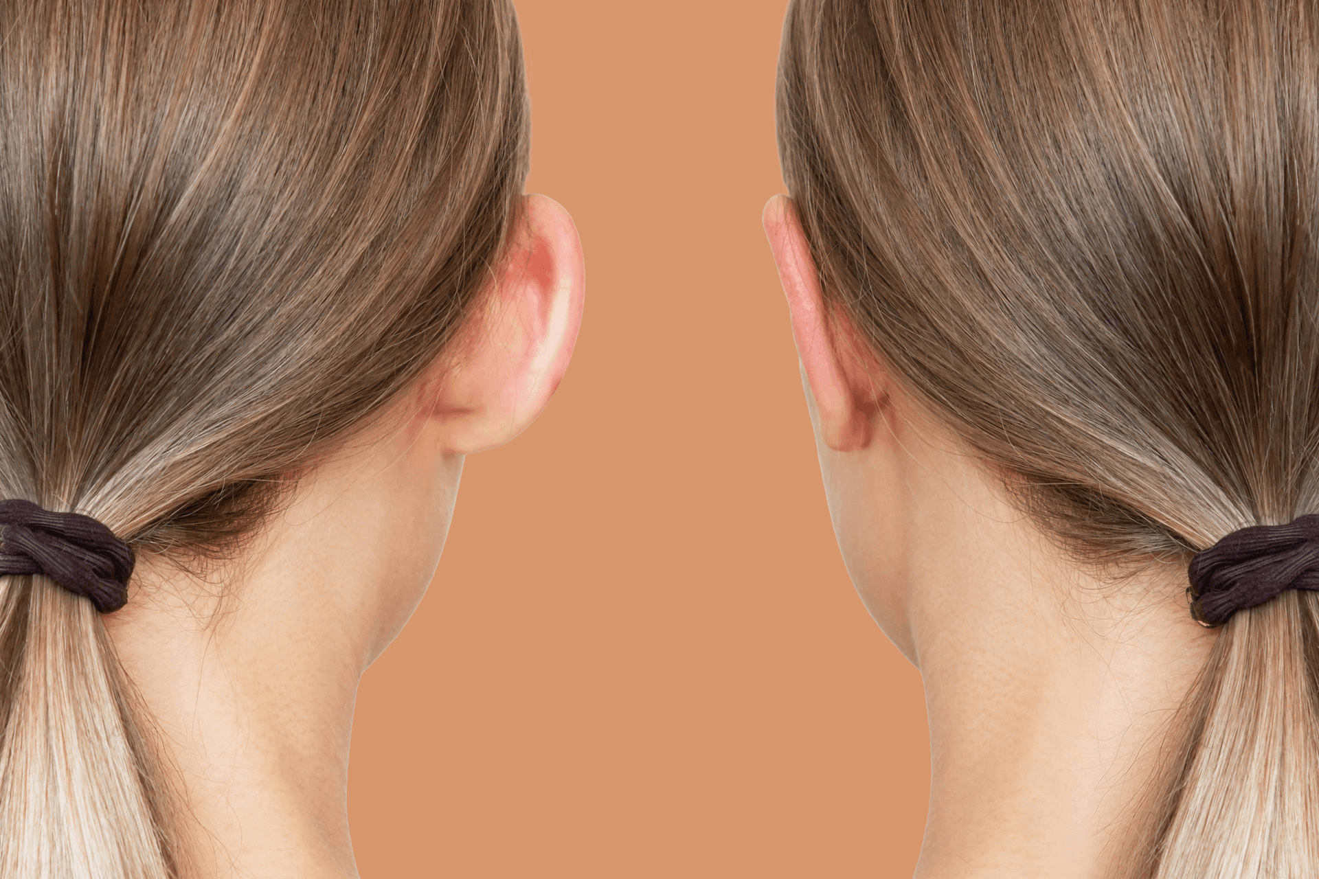 Otoplasty